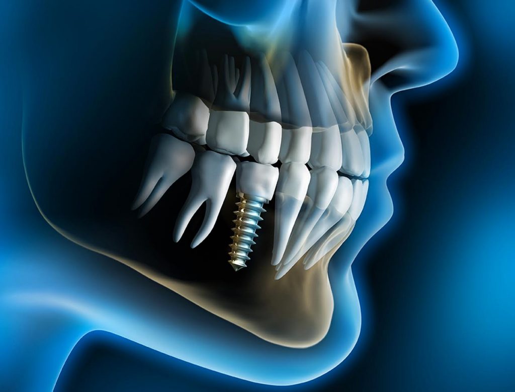 Dental implants treatment